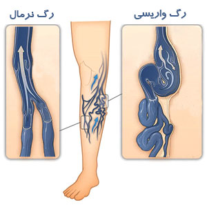 واریس پا